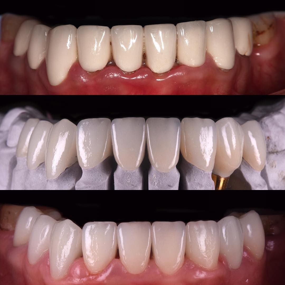 Implant dentar in Chisinau, cel mai bun pret
